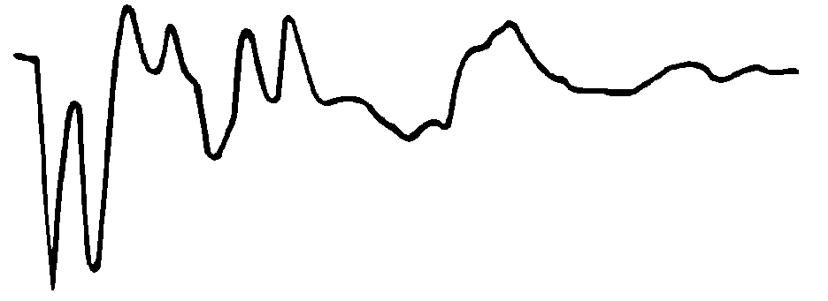 無遠(yuǎn)端短路環(huán)波形